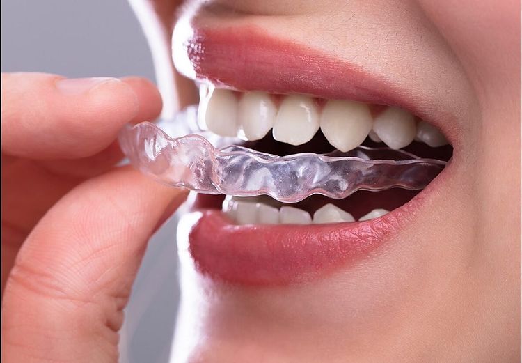 Invisalign Ortho