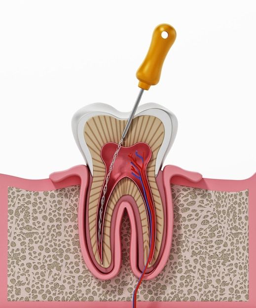 Root Canal Treatment & Filling