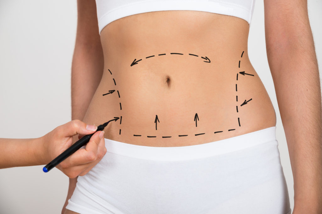 Tummy Tuck, Buttocks and Arms