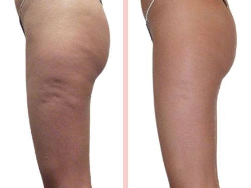 Remove Cellulite – Slouch & Dissolve Fat