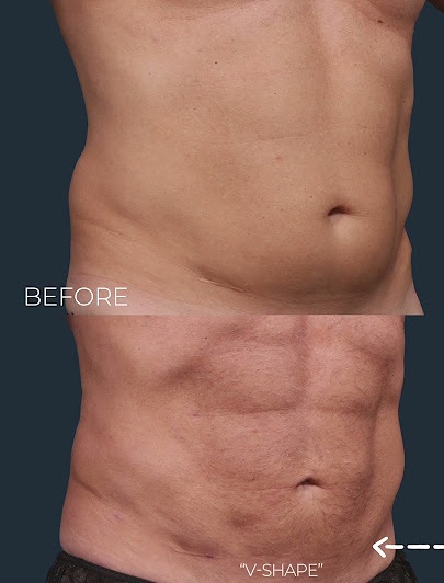 Liposuction & Body Sculpting