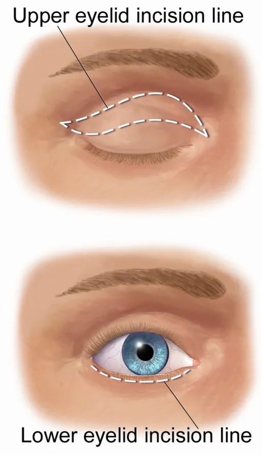 eyelid surgery